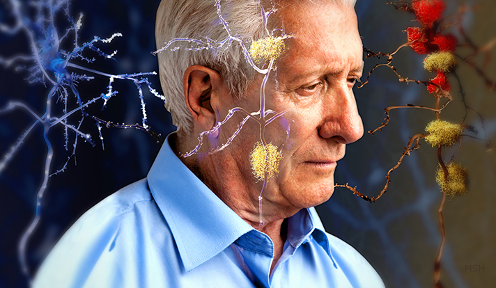 راه های پیشگیری از کوچک شدن مغز درمان آلزایمر پیشگیری از آلزایمر آلزایمر   