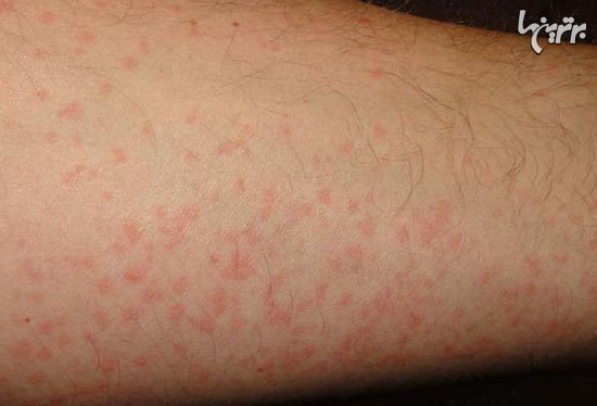 حساسیتهای عجیب به مواد غیرخوراکی حساسیتهای عجیب به مواد غیرخوراکی