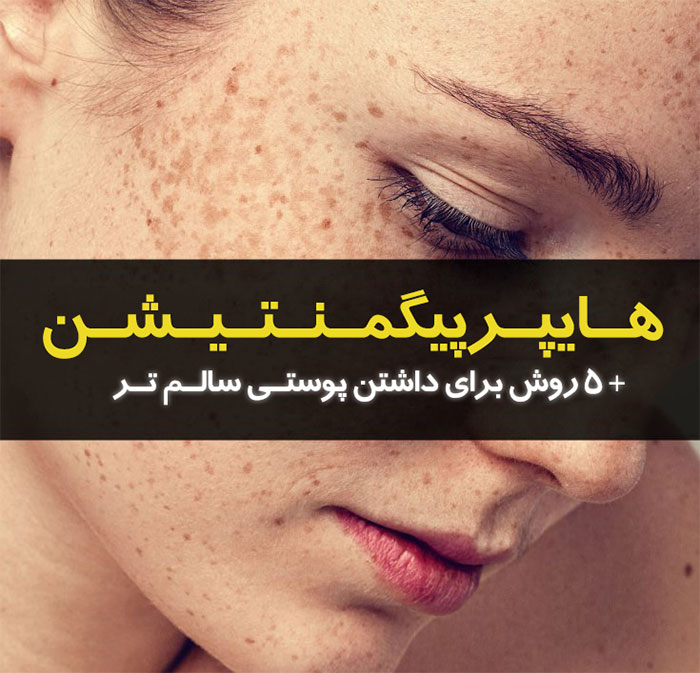هایپرپیگمنتیشن,درمان هایپرپیگمنتیشن,علل هایپرپیگمنتیشن