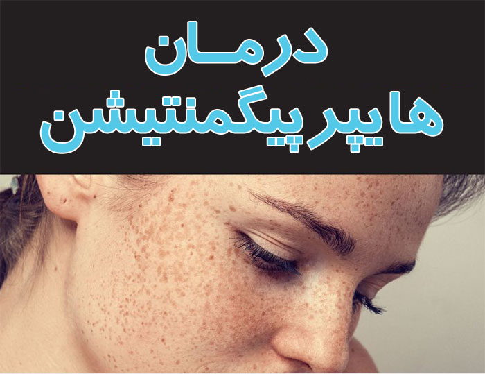 هایپرپیگمنتیشن,درمان هایپرپیگمنتیشن,علل هایپرپیگمنتیشن
