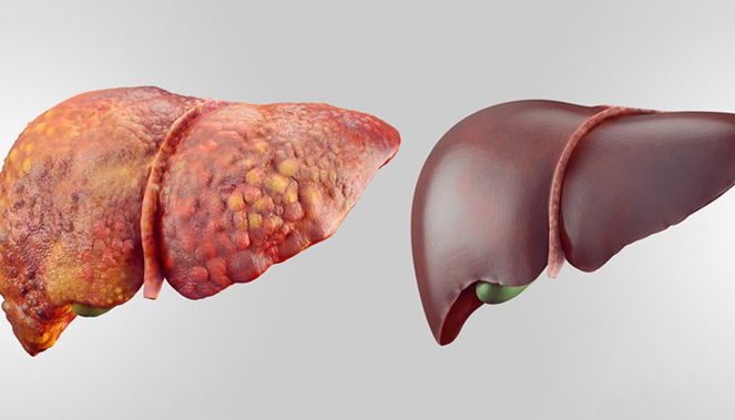 چگونه بر کبد چرب غلبه کنیم؟